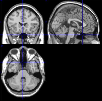 “Switch-Off” of Respiratory Sinus Arrhythmia May Be Associated With the Activation of an Oscillatory Source (Pacemaker) in the Brain Stem